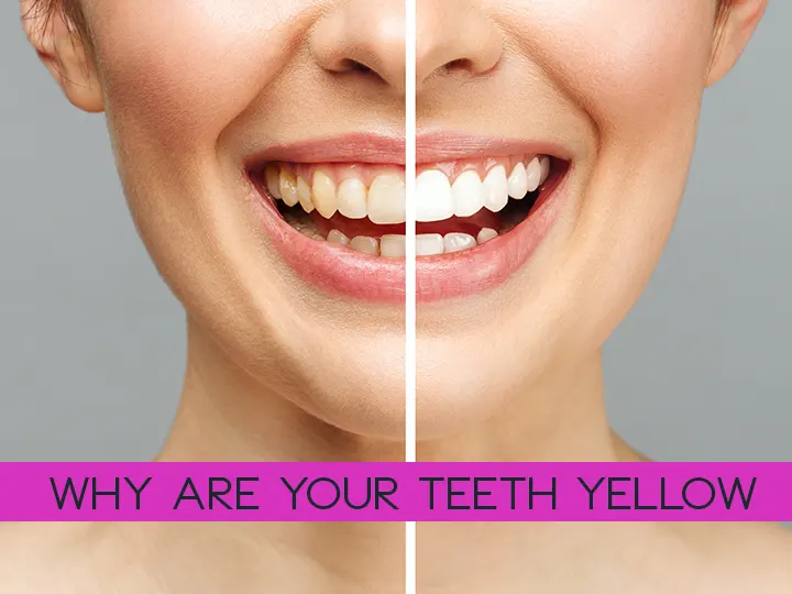 Why are Your Teeth Yellow?