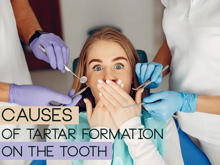 Causes of Tartar Formation on The Tooth