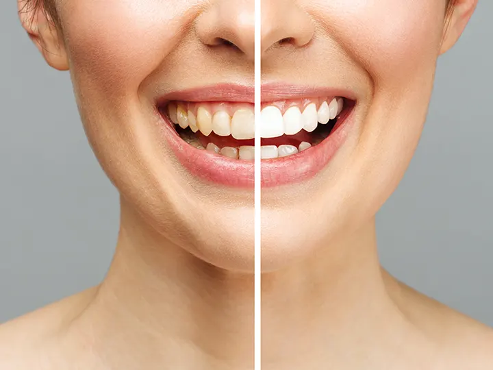 Is teeth whitening a harmful procedure?